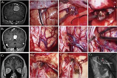 Bridging veins: an analysis of surgical anatomy and histology correlated with interhemispheric approaches